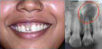 Treating Non-Vital Tooth with Apical Pathology with the help of MTA