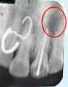 Treating Non-Vital Tooth with Apical Pathology with the help of MTA