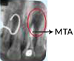 Treating Non-Vital Tooth with Apical Pathology with the help of MTA