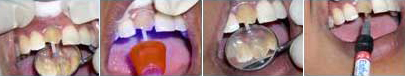 Treating Non-Vital Tooth with Apical Pathology with the help of MTA