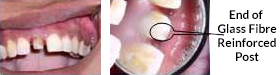 Treating Non-Vital Tooth with Apical Pathology with the help of MTA