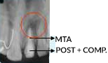 Treating Non-Vital Tooth with Apical Pathology with the help of MTA