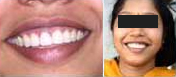 Treating Non-Vital Tooth with Apical Pathology with the help of MTA