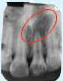 Treating Non-Vital Tooth with Apical Pathology with the help of MTA