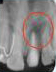 Treating Non-Vital Tooth with Apical Pathology with the help of MTA