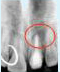 Treating Non-Vital Tooth with Apical Pathology with the help of MTA