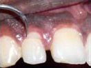 Tooth with Fracture Extending Sub-Gingivally