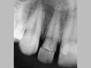 Tooth with Fracture Extending Sub-Gingivally