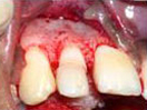 Tooth with Fracture Extending Sub-Gingivally