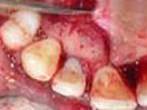 Tooth with Fracture Extending Sub-Gingivally
