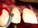 Tooth with Fracture Extending Sub-Gingivally