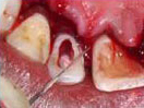 Tooth with Fracture Extending Sub-Gingivally