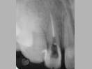 Tooth with Fracture Extending Sub-Gingivally