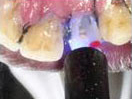 Tooth with Fracture Extending Sub-Gingivally
