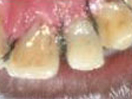 Tooth with Fracture Extending Sub-Gingivally