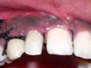 Tooth with Fracture Extending Sub-Gingivally