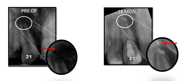 Regenerative Endodontic Procedure