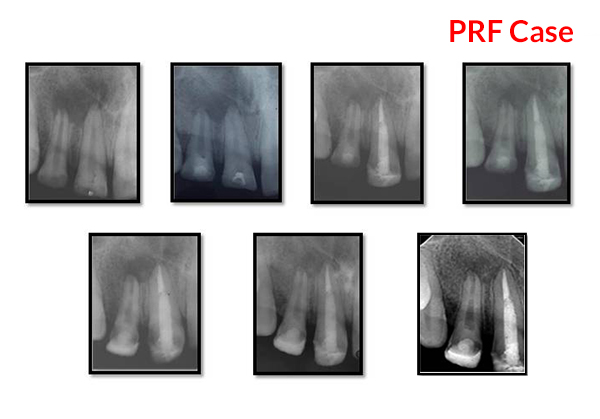 Dental Treatment