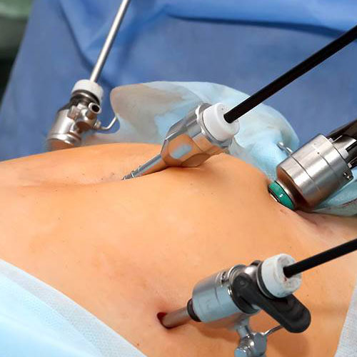 Fibroid Removal Surgeon in Kolkata