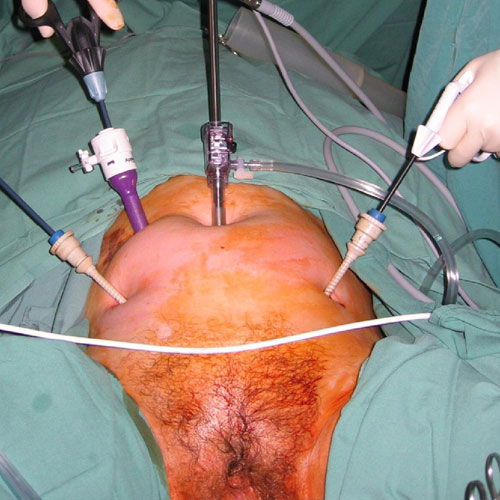 Laparoscopic Hysterectomy in Kolkata