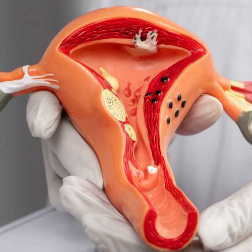 Myomectomy Doctor in Kolkata