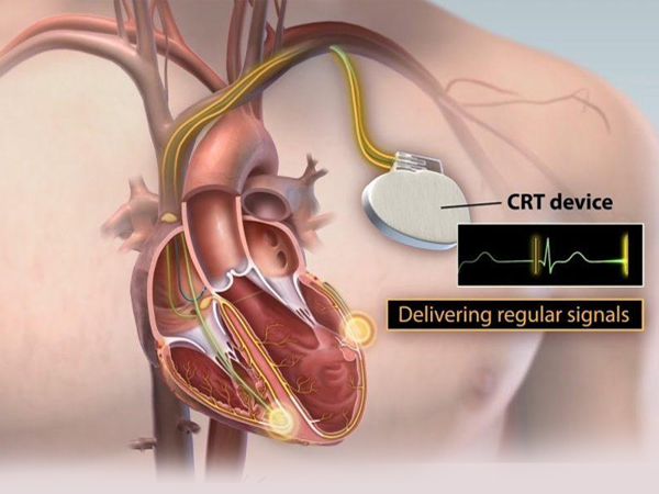 Cardiac Resynchronization Therapy (CRT-P / CRT-D)