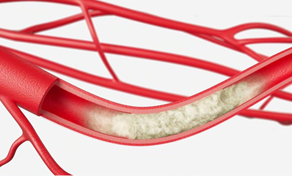 Chronic Total Occlusion (CTO)