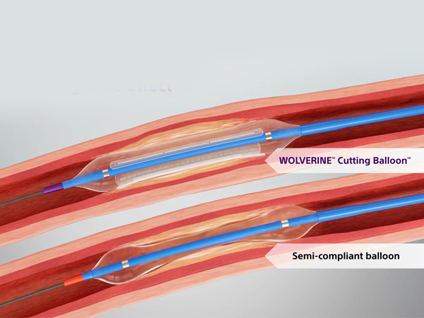 Cutting Balloon Angioplasty