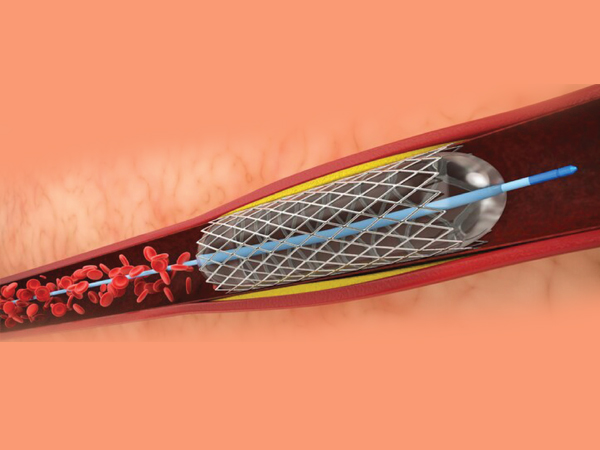 Fractional Flow Reserve (FFR) Assessment