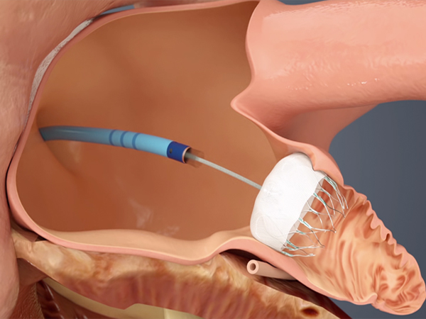 LAAC (Left Atrial Appendage Closure)