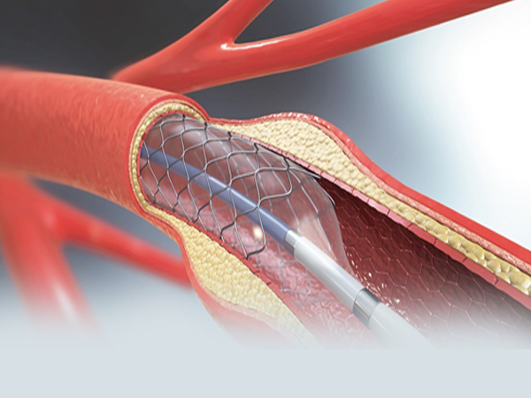 Left Main Angioplasty