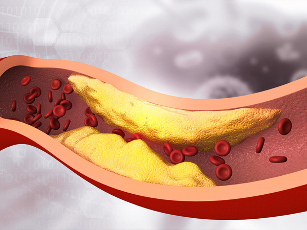 Peripheral Angioplasty