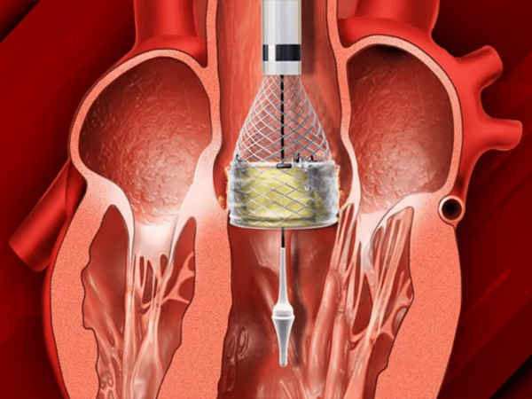 TAVI (Transcatheter Aortic Valve Implantation)